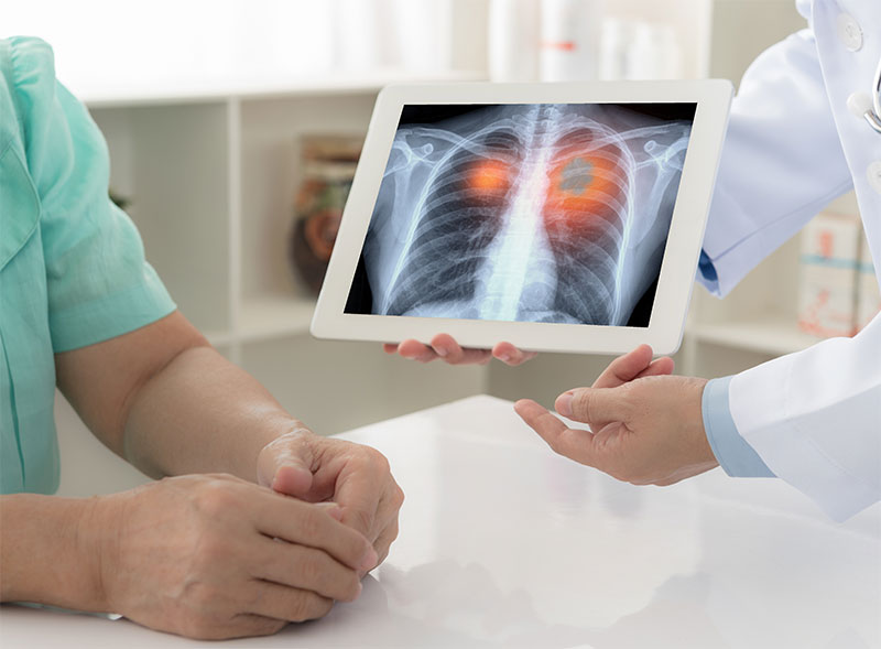 why-its-important-to-have-a-lung-cancer-screening-strip1